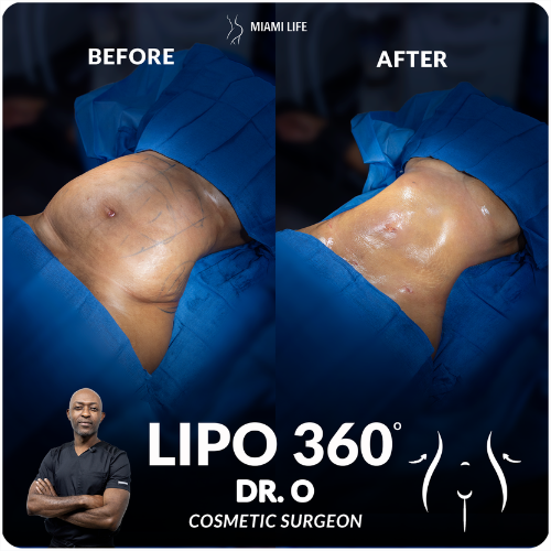 lipo-360-onyeka-miami-life-plastic-surgery