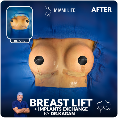 breast surgery, breast lift, implant exchange