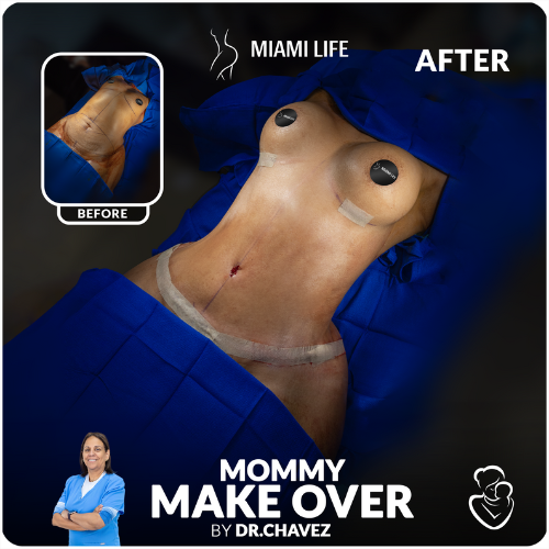 mommy-makeover-chavez-miami-life-plastic-surgery (1)