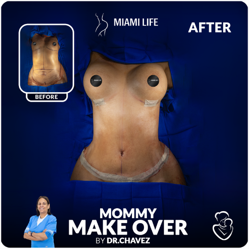 mommy-makeover-chavez-miami-life-plastic-surgery