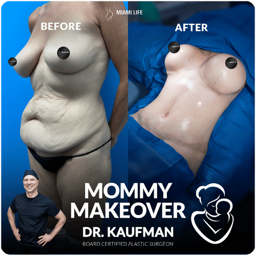 mommy-makeover-kaufman-miami-life-plastic-surgery