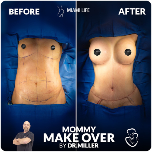 mommy-makeover-miller-miami-life-plastic-surgery-1